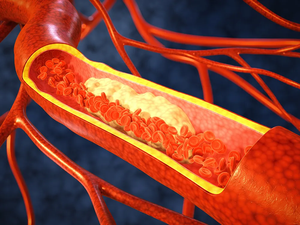 콜레스테롤 낮추는 방법