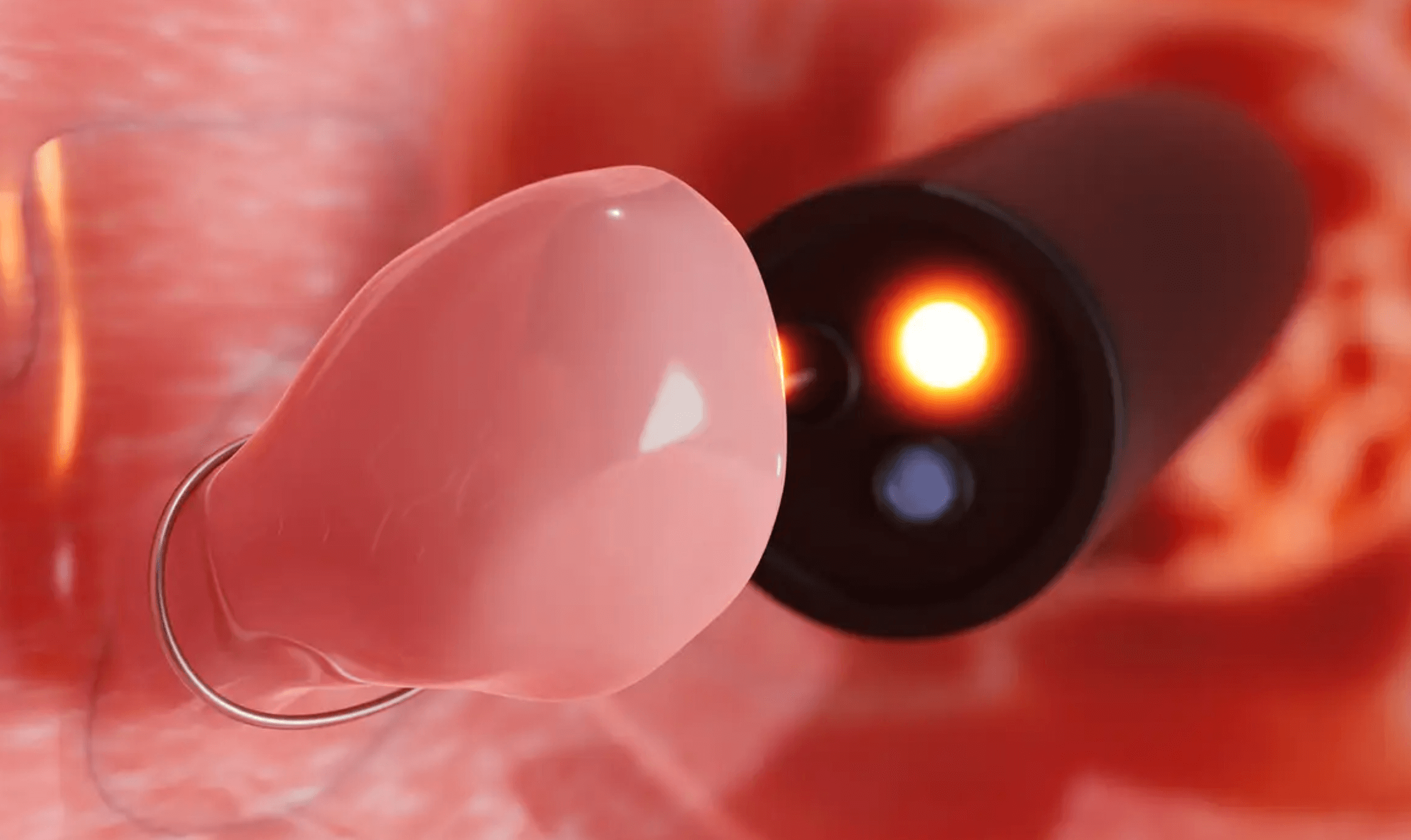 용종제거 보험청구