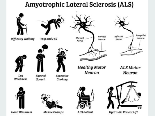 루게릭병의 증상들