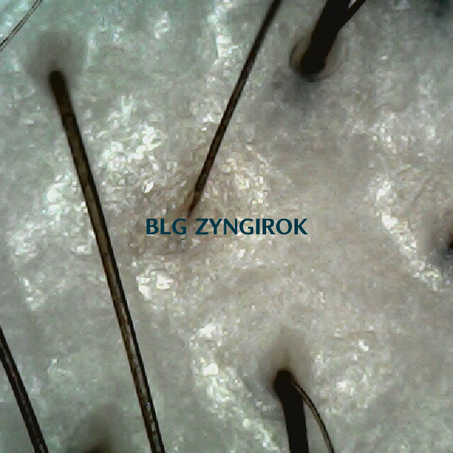 탈모 극복 프로젝트 - 정수리와 이마 사이 두피 모습이다.