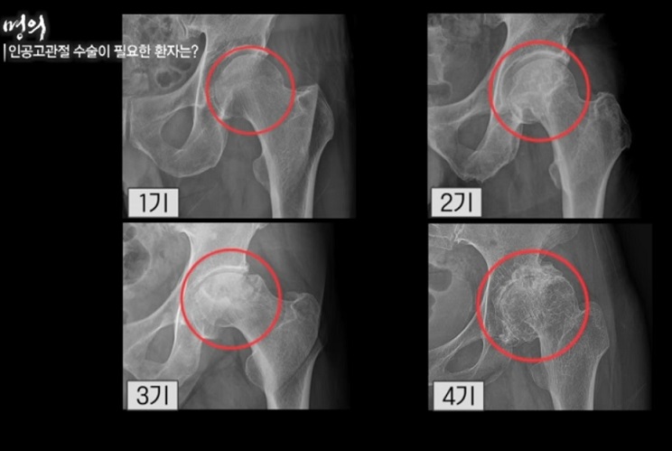 고관절-명의-전영수-교수