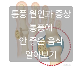 통풍 발작 후 회복: 빠르고 효과적으로 회복하는 방법