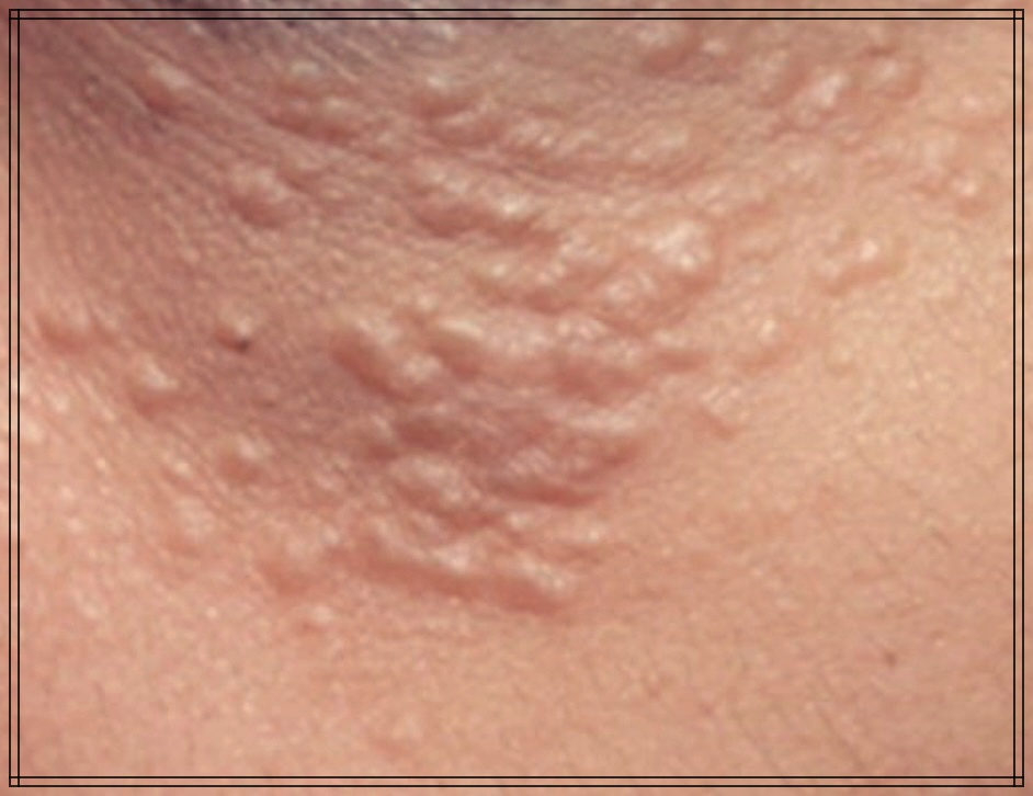 한관종 제거 후기: 내 경험을 공유합니다