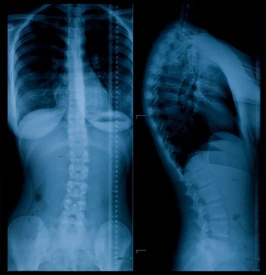 흉요추 골절(Thoracolumbar Fracture)의 원인과 치료