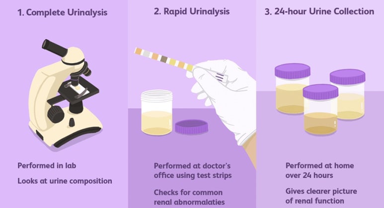 소변 침사 검사 (Urine Sediment Test)
