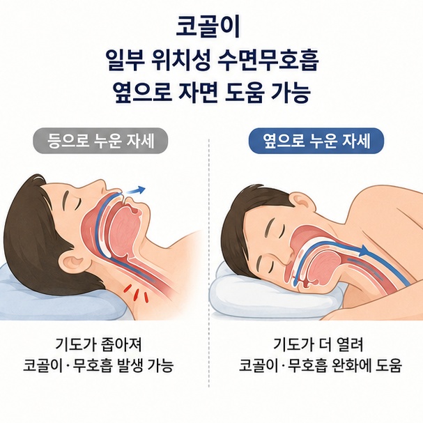 바로 누운 자세보다 옆으로 누운 자세가 일부 코골이와 위치성 수면무호흡에 도움이 될 수 있음을 설명한 이미지