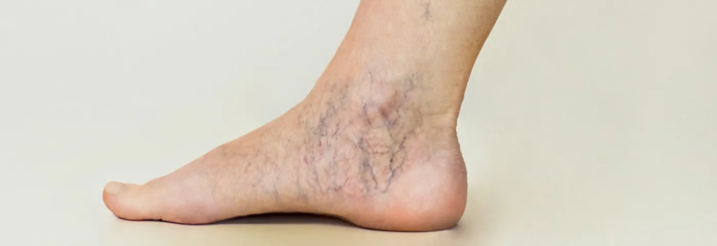 하지 정맥류 증상 치료방법과 예방 생활습관_8