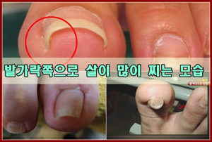 부산 내성발톱