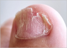 발톱무좀 증상 이미지들