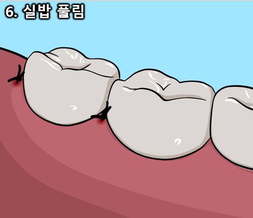 드라이 소켓, 사랑니 발치후 붓기 등 사랑니 발치 후 이상증상 완벽정리