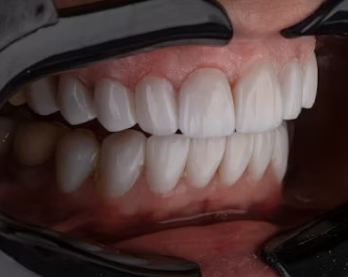 틀니 가격 의료보험적용 세척방법 보관법 종류