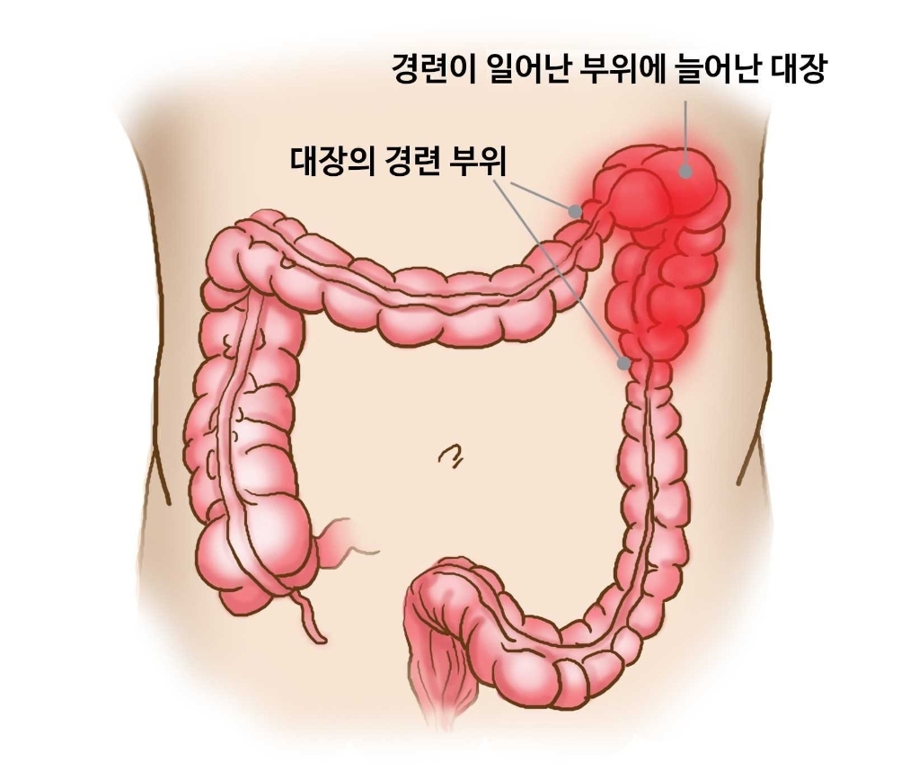 과민성대장 증후군 원인