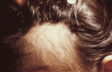 발모병으로 인해 머리카락이 가늘어지는 사람