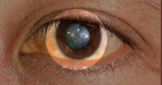 백내장 원인과 치료방법 