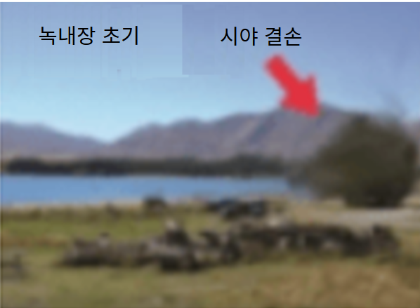 녹내장 증상 - 녹내장 초기 시력