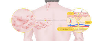 대상포진 가격알아보기