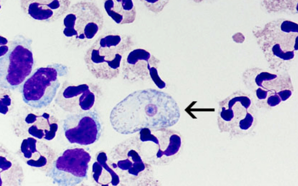 미국 뇌 먹는 아메바 네글레리아 파울러리