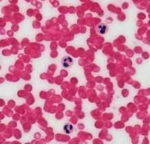 빈혈 치료방법 진단기준 합병증