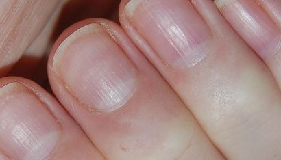 손톱 세로줄 무늬