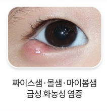 다래끼1