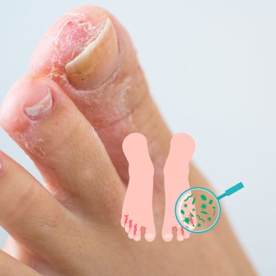 무좀 원인, 증상, 치료법 및 주의사항