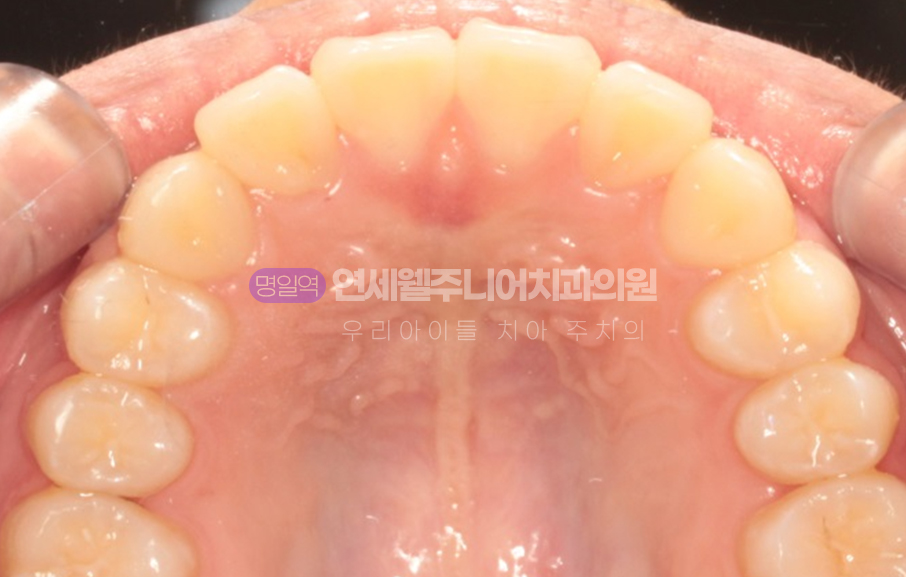 MTA 미니튜브 교정 후 위턱 앞니와 양측 치아 배열을 보여주는 교합면 사진