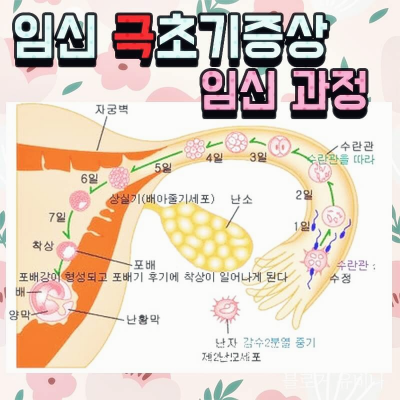 임신-극 초기-임신 과정