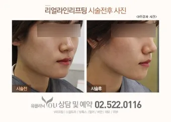 덴서티 리프팅 댄서티 가격 효과 유지기간에 관한 정보_11