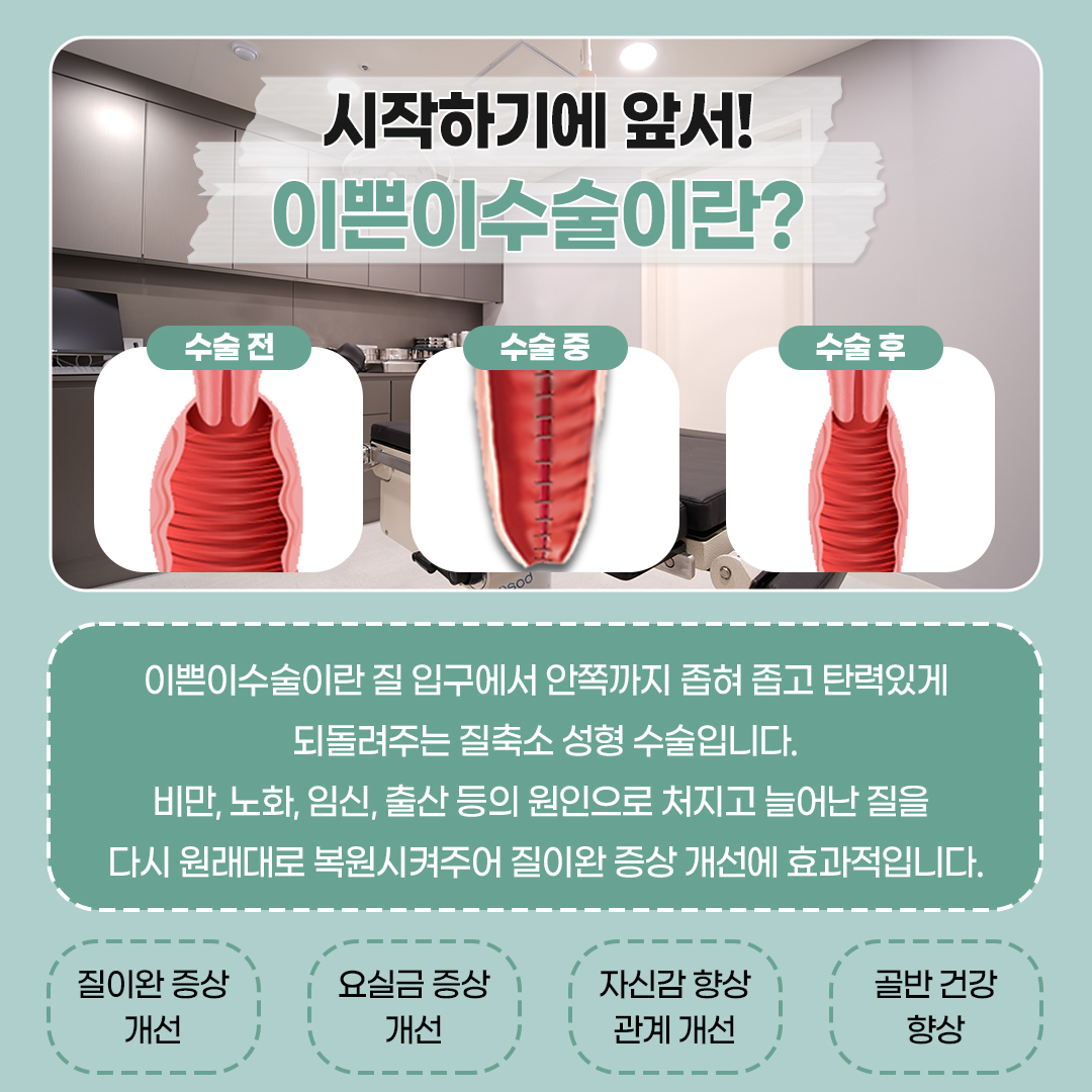 이쁜이수술 비용 후기 왜 병원마다 차이나는 건가요?