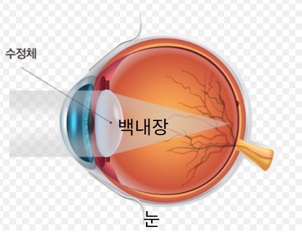 백내장 생기는 이유, 증상, 수술 방법