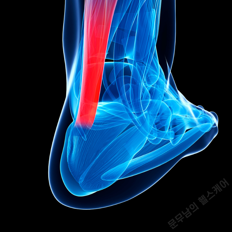 아킬레스건염 증상