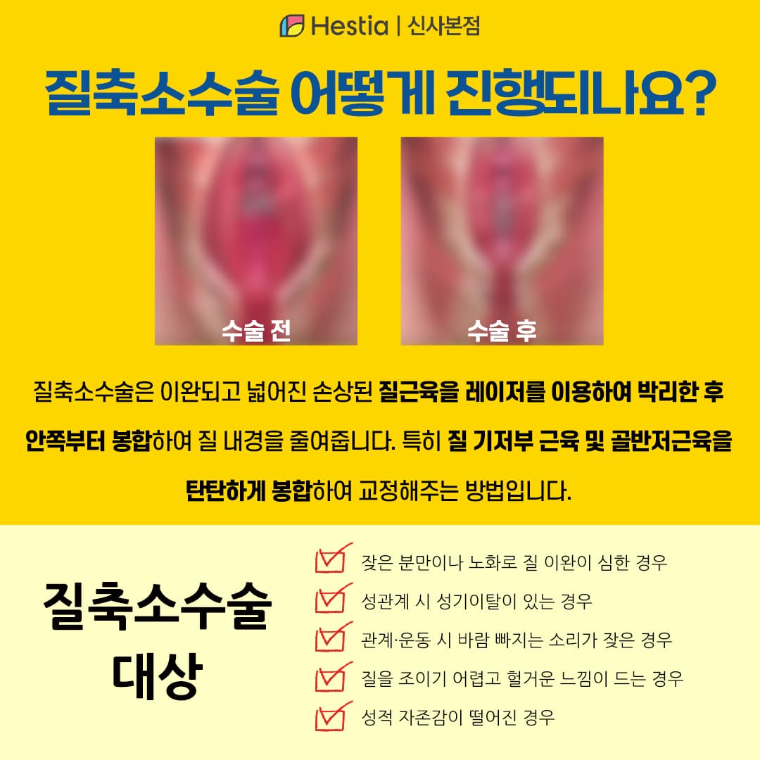 질축소수술이란?