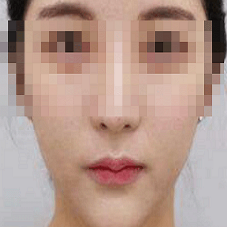 올리지오-리프팅-후-사진