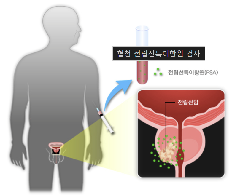 전립선 비대증