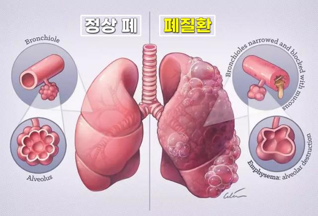 숨쉬기 답답 기침 만성 폐쇄성 폐질환 증상