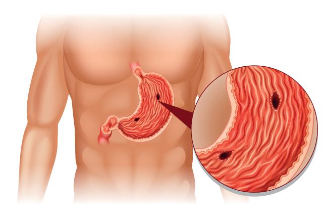 소금 섭취 줄이면 효능 위암