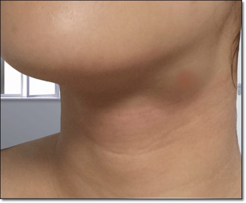 임파선부었을때