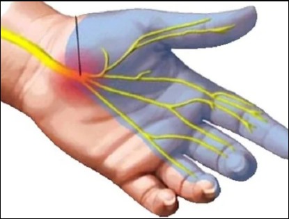 손목터널증후군 증상 -3