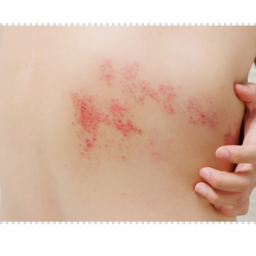 귀 대상포진 증상 후유증