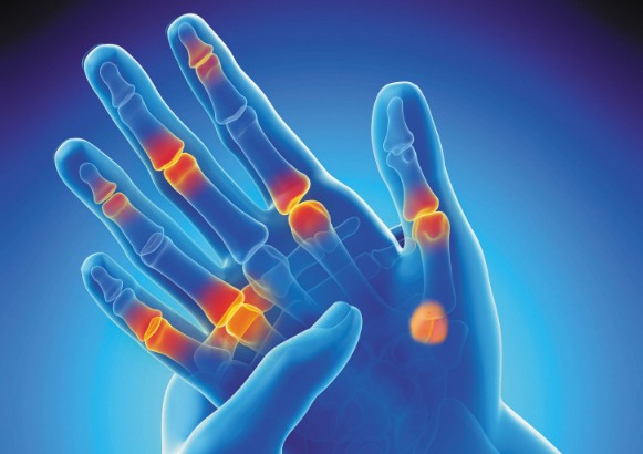 손가락 관절염 : 통증, 원인, 증상