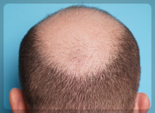 대머리가되는꿈