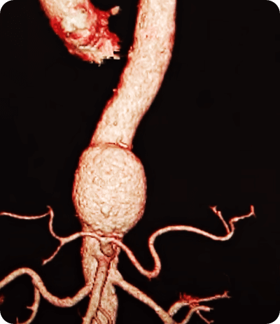 대동맥류-사진-(출처-SBS)
