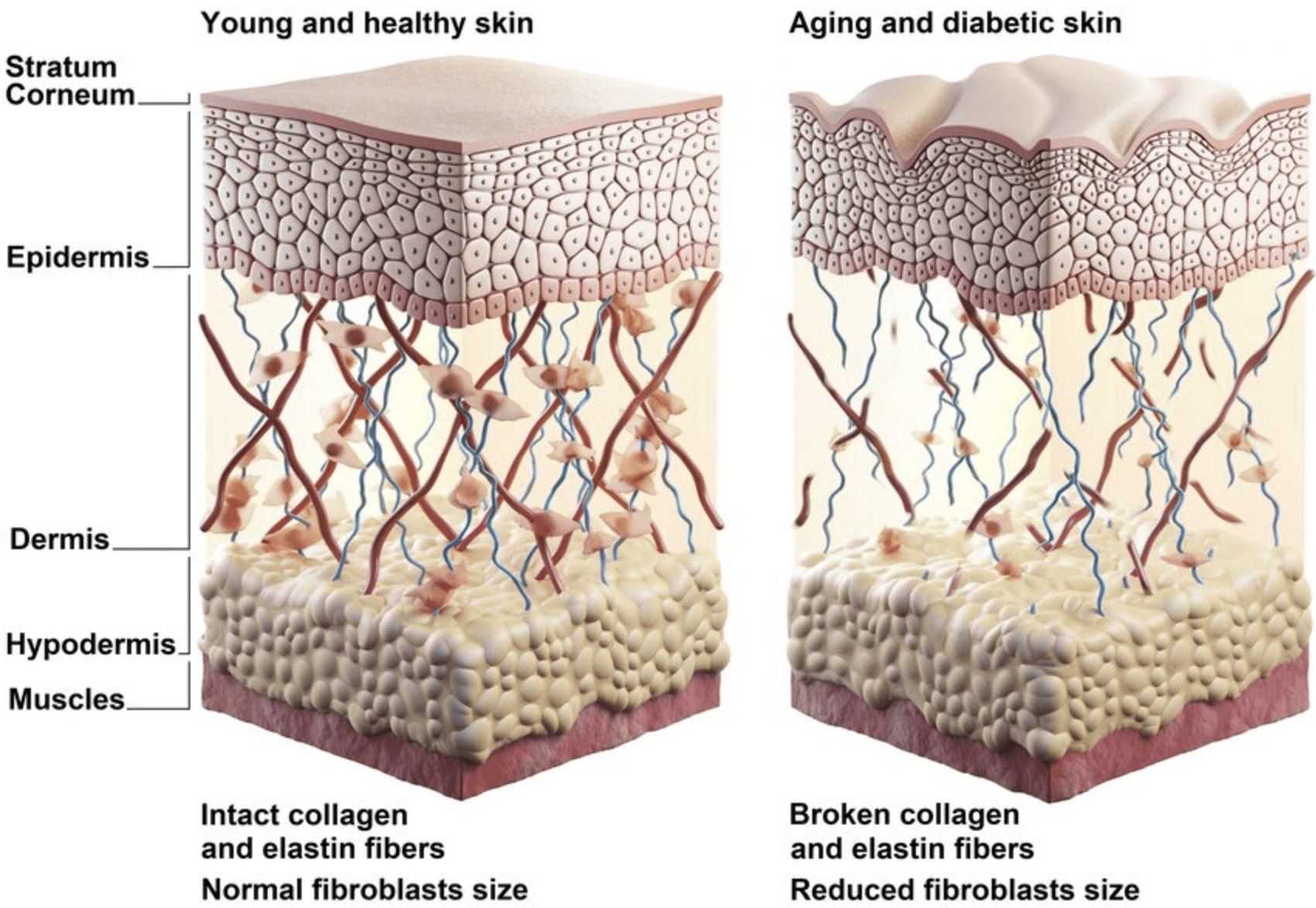 피부과리프팅레이저 시술 고민이라면? 고주파(RF) 리프팅 시술 비교 