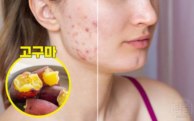 여드름흉터 치료 여드름흉터 없애는법 자연치유