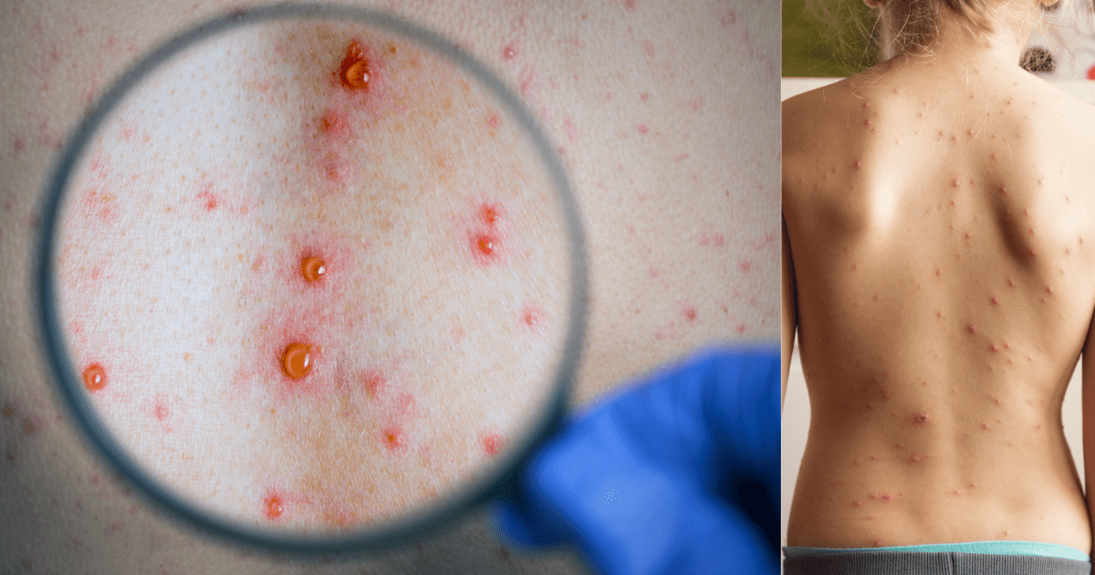 대상포진 물집과 대상포진이 퍼져있는 등