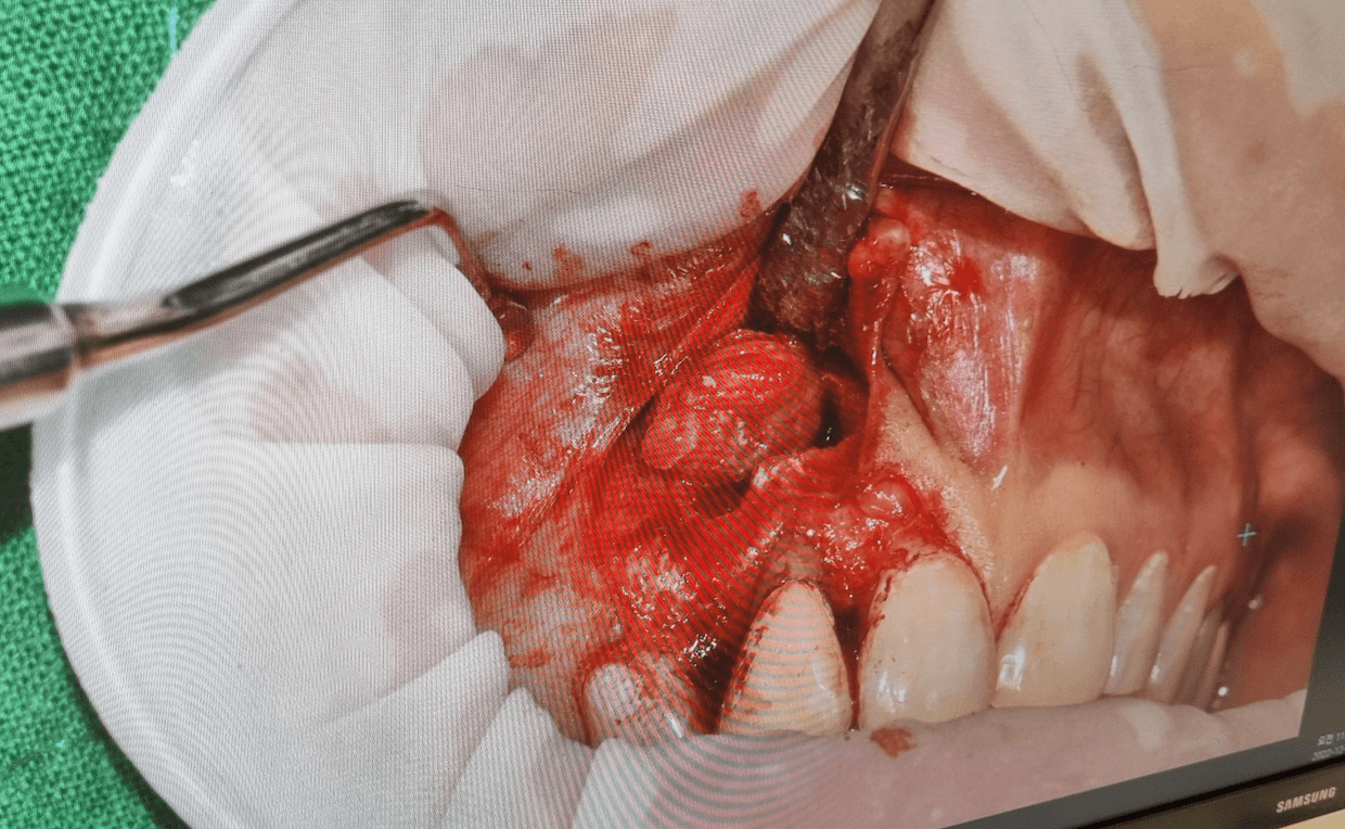 치근단절제술 뼈이식