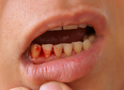 잇몸에서 피가나는 모습