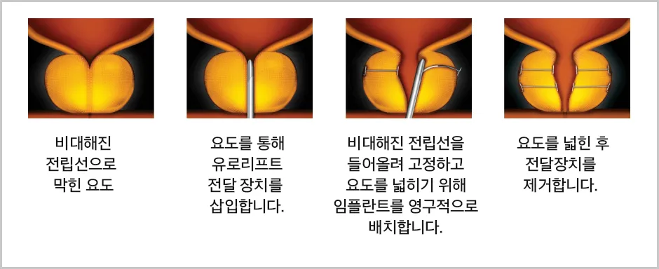 전립선-요도-리프트-단계별-설명