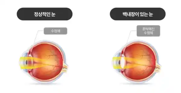 백내장 사진
