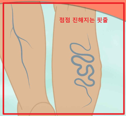 하지정맥류
